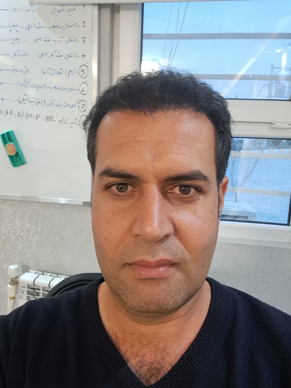 کلینیک کاشت مو در شیراز 5